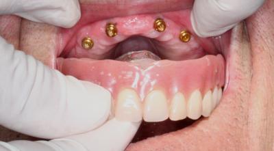 Image Implant Supported Overdentures