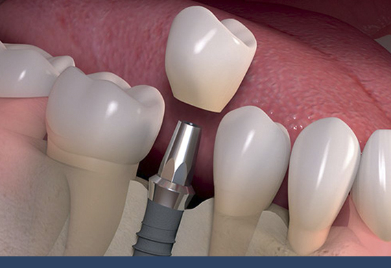 Image denta limplants dentallaser